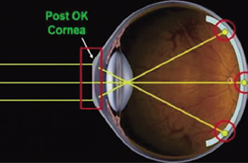 近視矯正?？?/>
      <div   id=